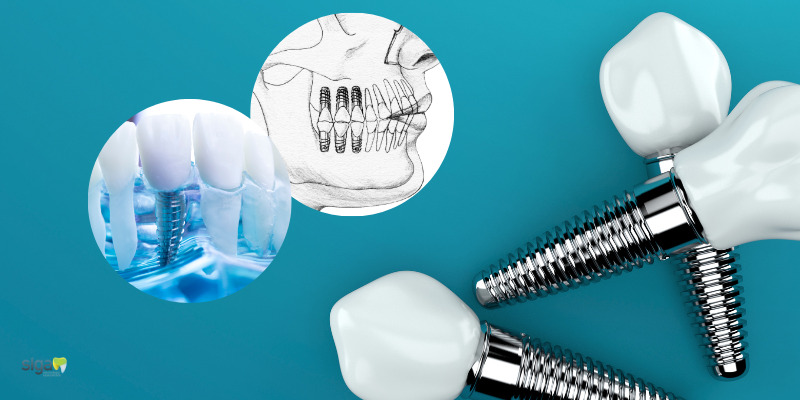 Osseointegração: A Ciência por Trás dos Implantes Dentários