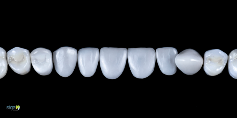 Como Funcionam as Facetas Dentárias EMAX